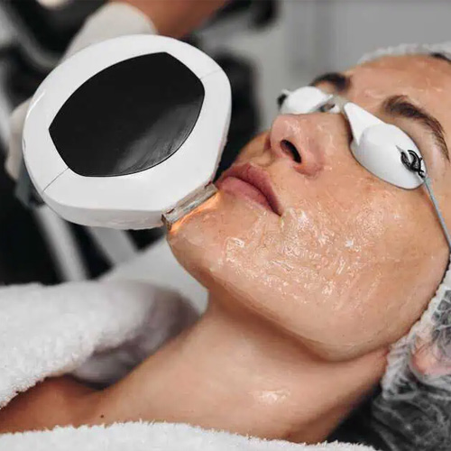 Photofacial IPL